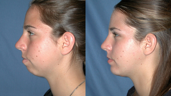 Genioplasty Results