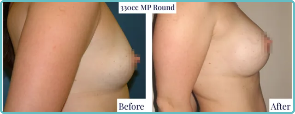 Breast Implants & Enlargement Porfolio Before and After Images