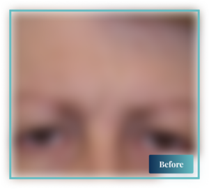 Blepharoplasty Sydney