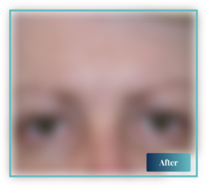 Blepharoplasty Sydney