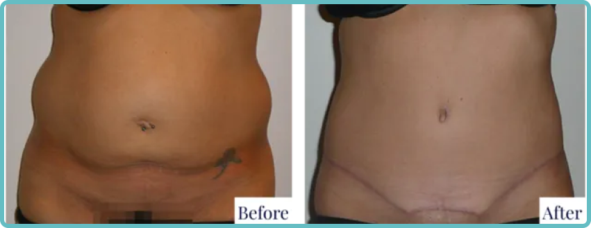 Abdominoplasty Surgery Gallery Before and After Image