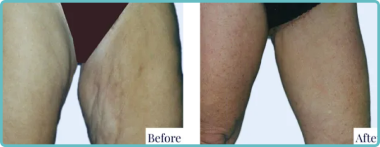 Seamless Thigh Lift by Dr. Mark Kohout