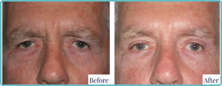 Eyelid Surgery Before and After Photo - Dr Mark Kohout