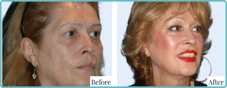 Facelift Surgery Before and After by Dr Mark Kohout