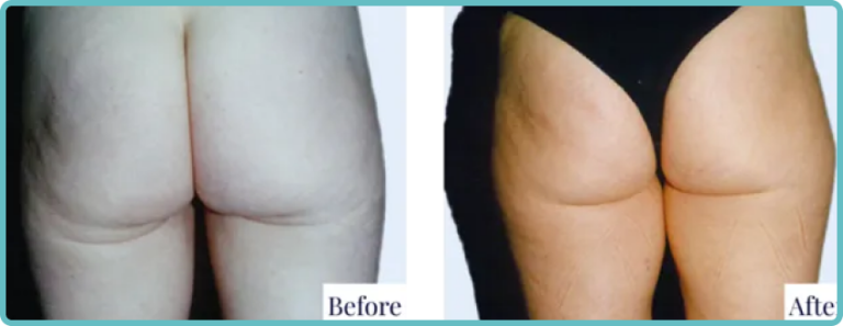 Patient 1 - Seamless Thigh Lift by Dr. Mark Kohout