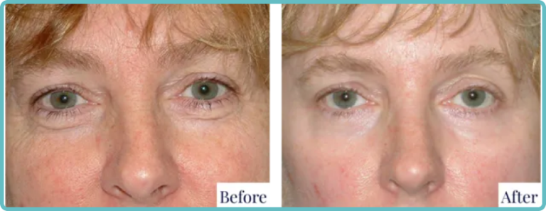 Eyelid Surgery Before and After Photo - Dr Mark Kohout