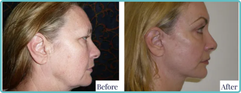 Facelift Surgery Before and After by Dr Mark Kohout