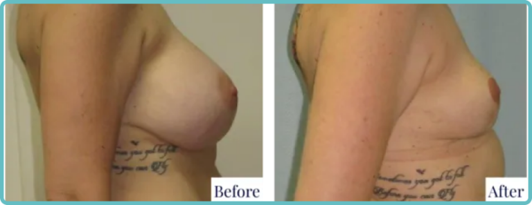 Natural-Look Breast Revision by Dr. Mark Kohout