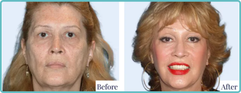 Facelift Surgery Before and After by Dr Mark Kohout