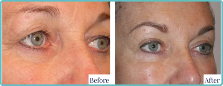 Eyelid Surgery Before and After Photo - Dr Mark Kohout