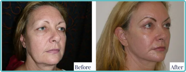 Facelift Surgery Before and After by Dr Mark Kohout