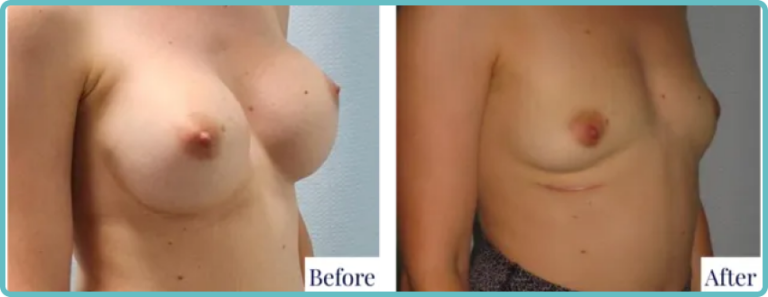Natural-Look Breast Revision by Dr. Mark Kohout