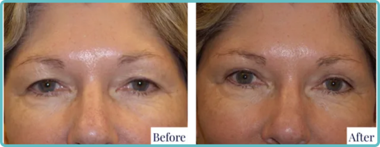Eyelid Surgery Before and After Photo - Dr Mark Kohout
