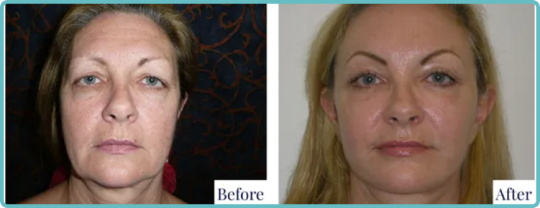 Facelift Surgery Before and After by Dr Mark Kohout