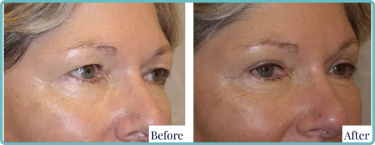 Eyelid Surgery Before and After Photo - Dr Mark Kohout