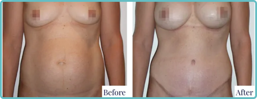 Abdominoplasty Surgery Gallery Before and After Image