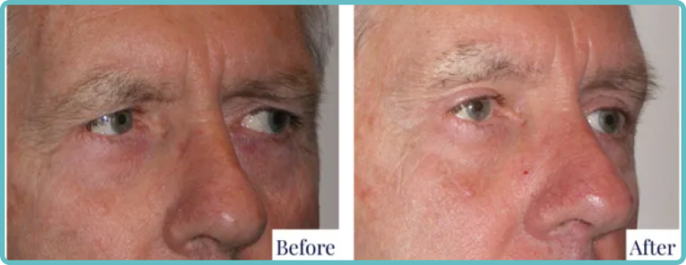 Eyelid Surgery Before and After Photo - Dr Mark Kohout
