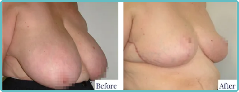Breast Reduction Surgery Patient