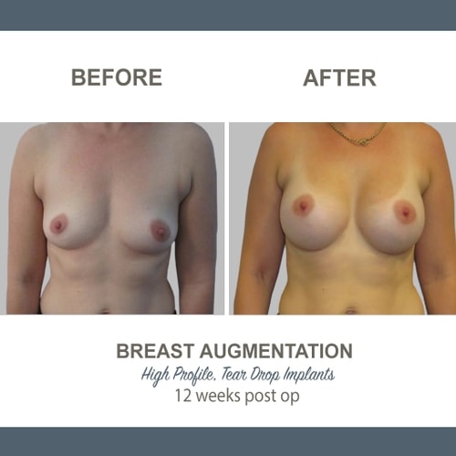 Breast Augmentation Tear Drop Implants -11 - High Profile 12 weeks Post Op