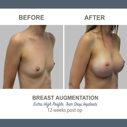Breast Augmentation Tear Drop Implants -2-5 - High Profile 12 weeks Post Op