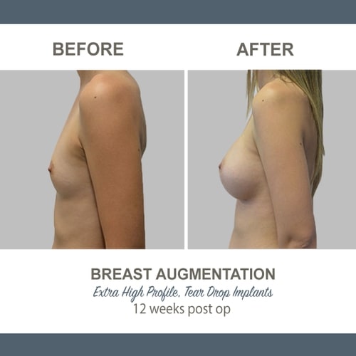 Breast Augmentation Tear Drop Implants -3-3 - High Profile 12 weeks Post Op