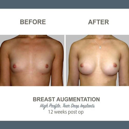 Breast Augmentation Tear Drop Implants -4 - High Profile 12 weeks Post Op