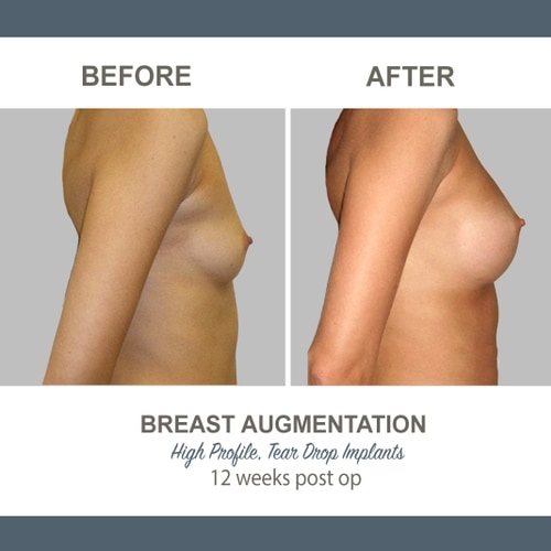 Breast Augmentation Tear Drop Implants -5 - High Profile 12 weeks Post Op