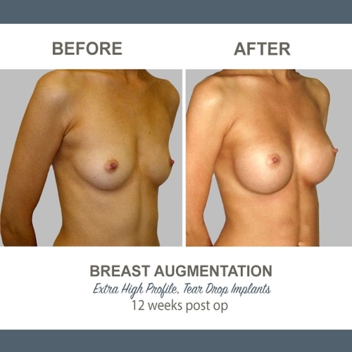 Breast Augmentation Tear Drop Implants -6 - High Profile 12 weeks Post Op