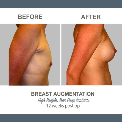Breast Augmentation Tear Drop Implants -7 - High Profile 12 weeks Post Op