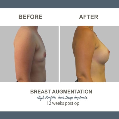 Breast Augmentation Tear Drop Implants -8 - High Profile 12 weeks Post Op