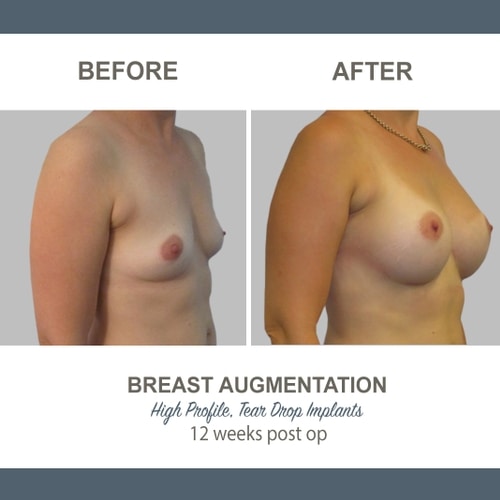 Breast Augmentation Tear Drop Implants -9 - High Profile 12 weeks Post Op