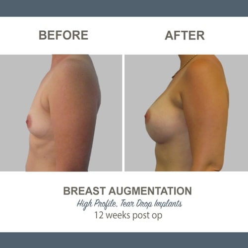 Breast Augmentation Tear DropImplants -1-5 - High Profile 12 weeks Post Op