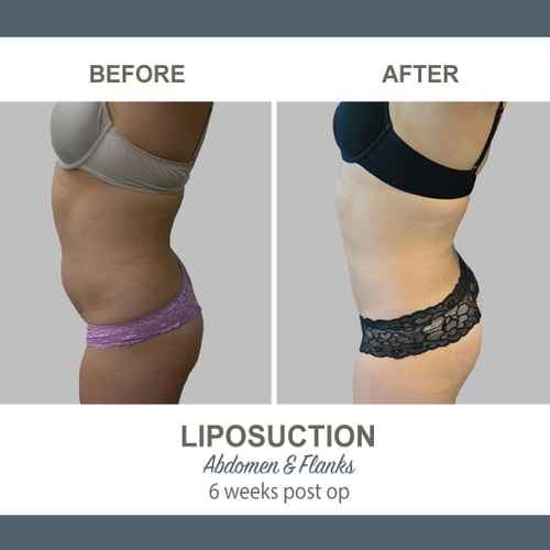 Liposuction Before and After Photos 10-1 Abdomen and Flanks