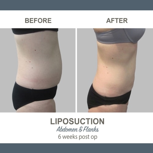 Liposuction Before and After Photos 12 Abdomen and Flanks