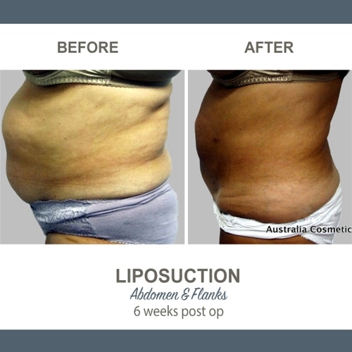 Liposuction Before and After Photos 13 Abdomen and Flanks