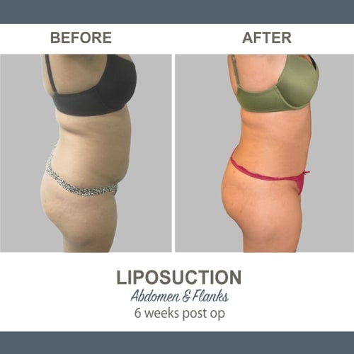 Liposuction Before and After Photos 14 Abdomen and Flanks