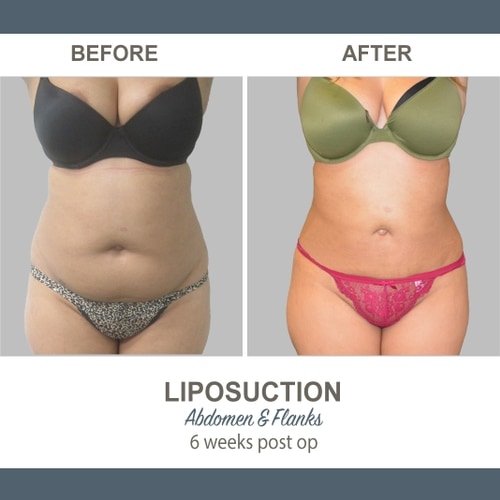 Liposuction Before and After Photos 15 Abdomen and Flanks