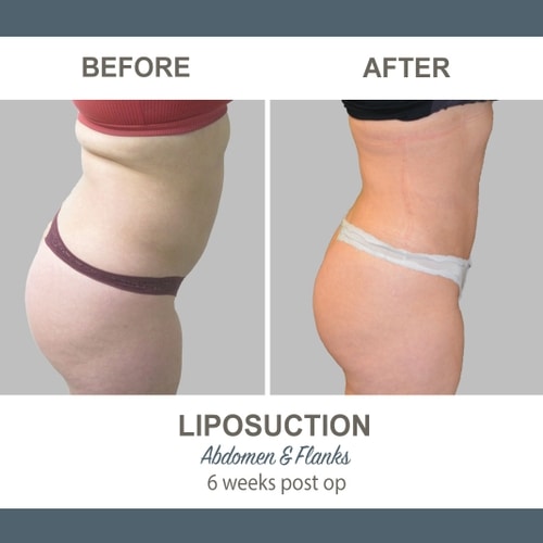 Liposuction Before and After Photos 16 Abdomen and Flanks