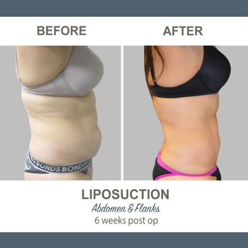 Liposuction Before and After Photos 17 Abdomen and Flanks