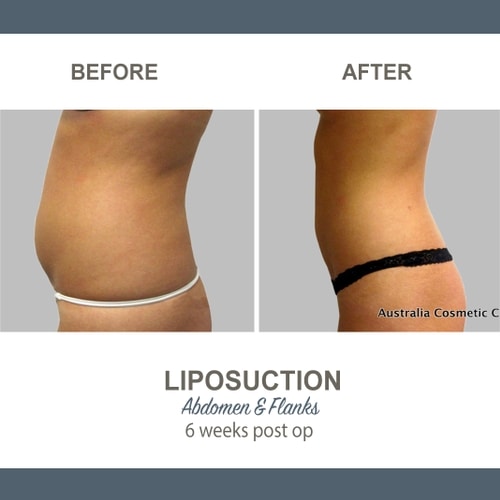 Liposuction Before and After Photos 18 Abdomen and Flanks