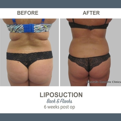 Liposuction Before and After Photos 19 Abdomen and Flanks