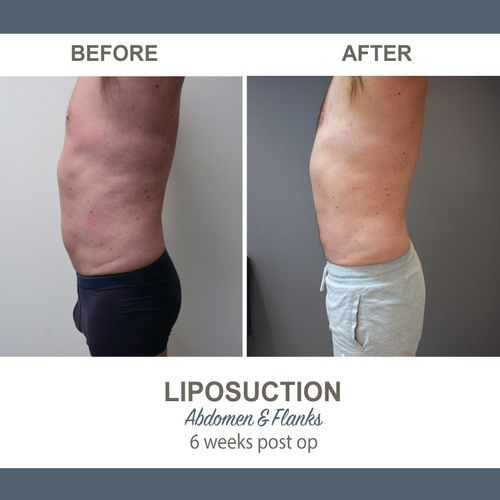 Liposuction Before and After Photos 2-6 Abdomen and Flanks