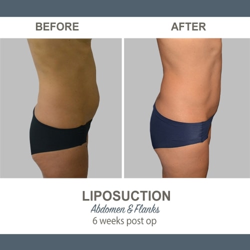 Liposuction Before and After Photos 20 Abdomen and Flanks