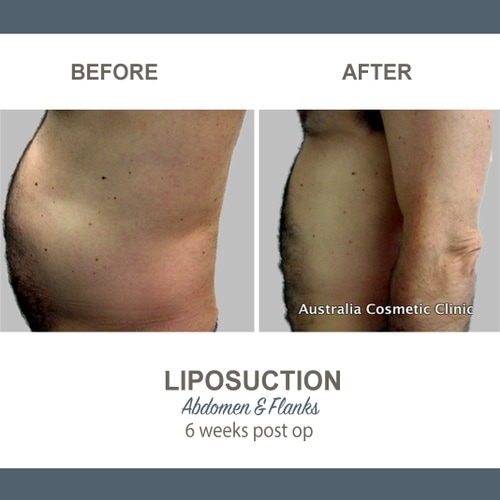 Liposuction Before and After Photos 21 Abdomen and Flanks