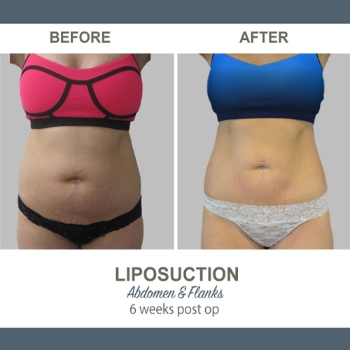 Liposuction Before and After Photos 22 Abdomen and Flanks