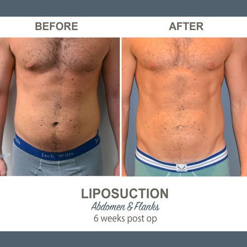 Liposuction Before and After Photos 3-4 Abdomen and Flanks