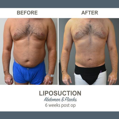 Liposuction Before and After Photos 4-1 Abdomen and Flanks