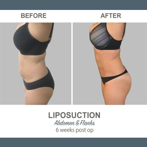 Liposuction Before and After Photos 5-1 Abdomen and Flanks