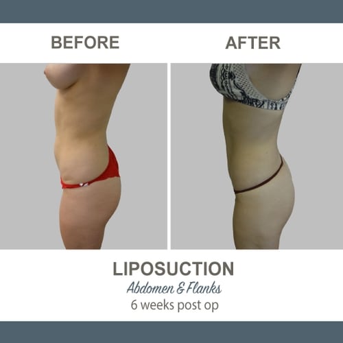 Liposuction Before and After Photos 6-1 Abdomen and Flanks