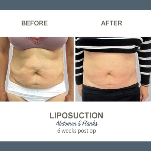 Liposuction Before and After Photos 7-1 Abdomen and Flanks